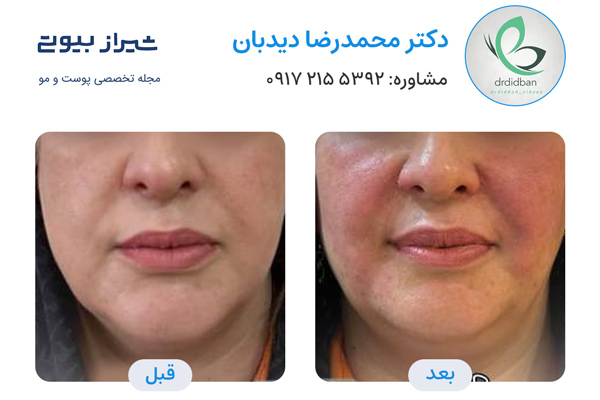 بوتاکس در شیراز - دکتر محمدرضا دیدبان