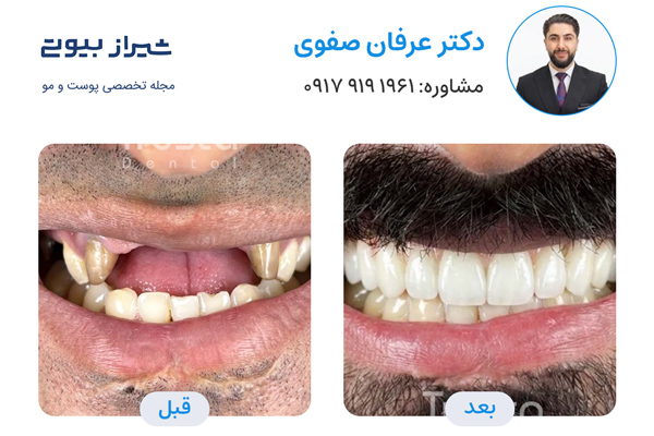 لمینت دندان در شیراز - دکتر عرفان صفوی