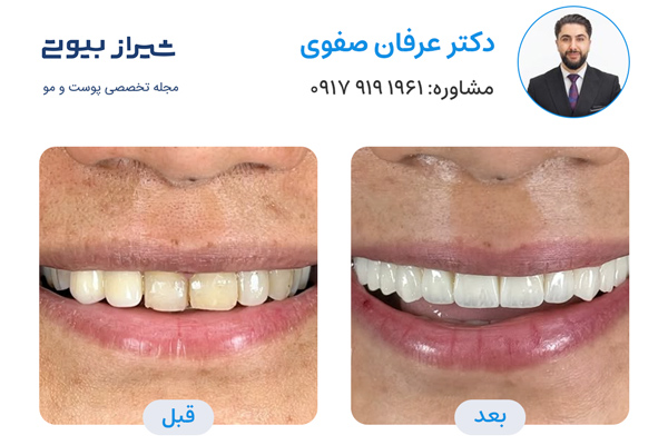 لمینت دندان در شیراز - دکتر عرفان صفوی