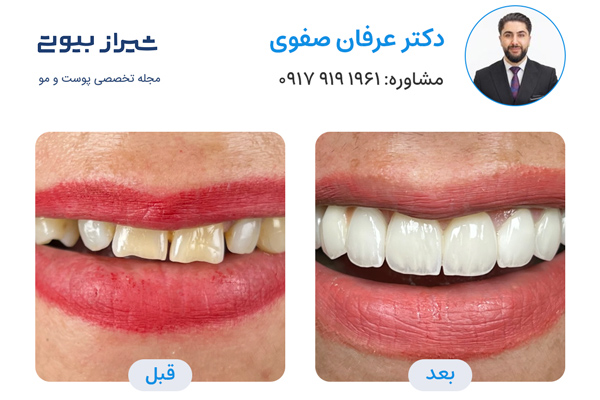 لمینت دندان در شیراز - دکتر عرفان صفوی