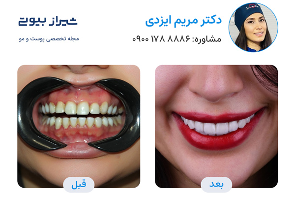 لمینت دندان در شیراز - دکتر مریم ایزدی