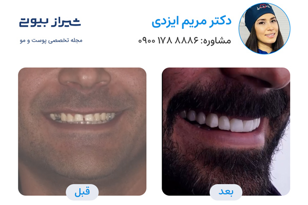 لمینت دندان در شیراز - دکتر مریم ایزدی