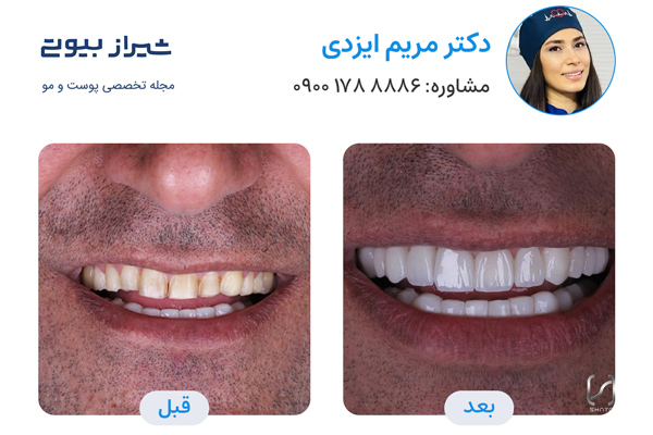 لمینت دندان در شیراز - دکتر مریم ایزدی