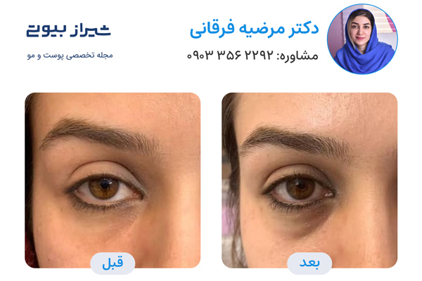تزریق بوتاکس در شیراز - دکتر مرضیه فرقانی