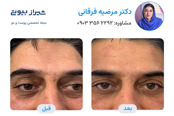 تزریق بوتاکس در شیراز - دکتر مرضیه فرقانی