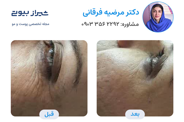 تزریق بوتاکس در شیراز - دکتر مرضیه فرقانی