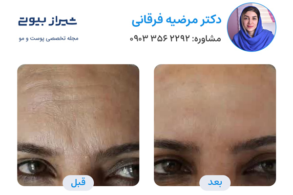 تزریق بوتاکس در شیراز - دکتر مرضیه فرقانی