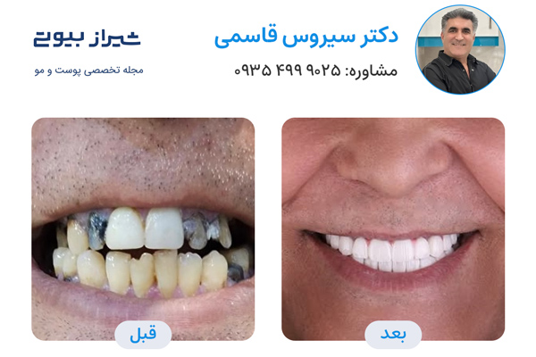 بهترین دکتر لمینت دندان در شیراز - دکتر سیروس قاسمی