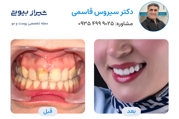 بهترین دکتر لمینت دندان در شیراز - دکتر سیروس قاسمی