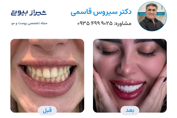 بهترین دکتر لمینت دندان در شیراز - دکتر سیروس قاسمی