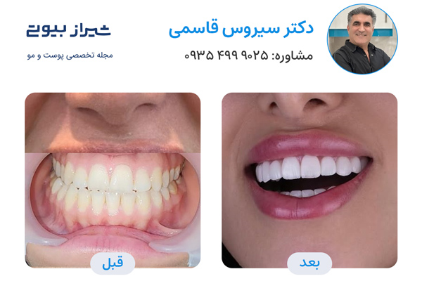 بهترین دکتر لمینت دندان در شیراز - دکتر سیروس قاسمی