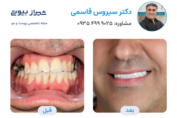 بهترین دکتر لمینت دندان در شیراز - دکتر سیروس قاسمی