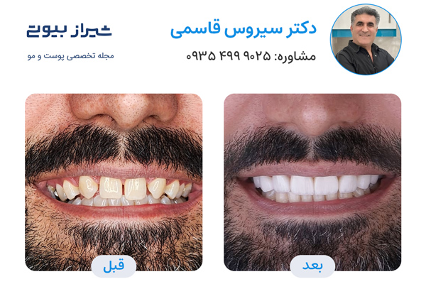 بهترین دکتر لمینت دندان در شیراز - دکتر سیروس قاسمی