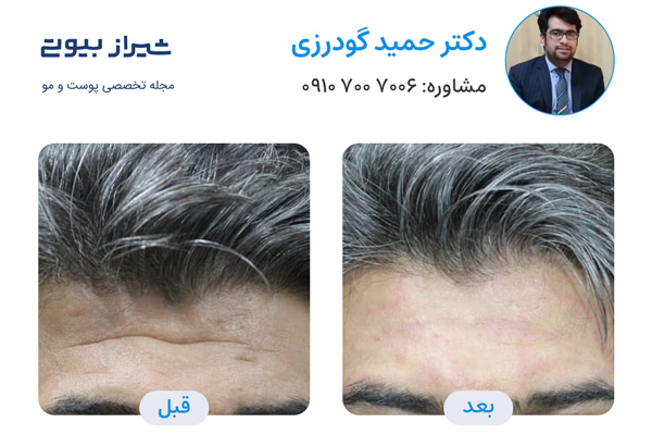 بهترین دکتر تزریق بوتاکس در شیراز - دکتر حمید گودرزی