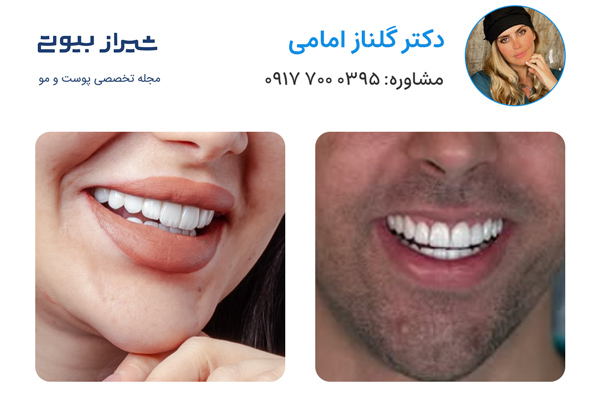 لمینت دندان در شیراز - دکتر گلناز امامی
