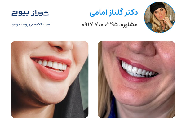 لمینت دندان در شیراز - دکتر گلناز امامی