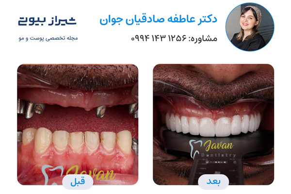 ایمپلنت دندان در شیراز - دکتر عاطفه صادقیان جوان