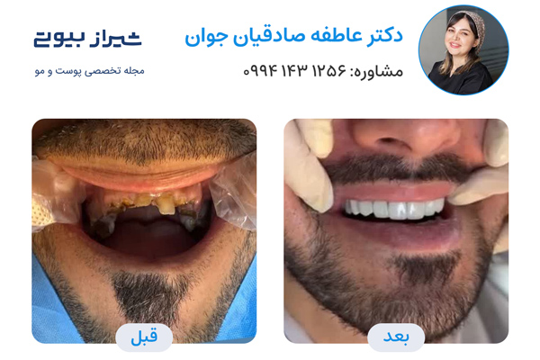 ایمپلنت دندان در شیراز - دکتر عاطفه صادقیان جوان