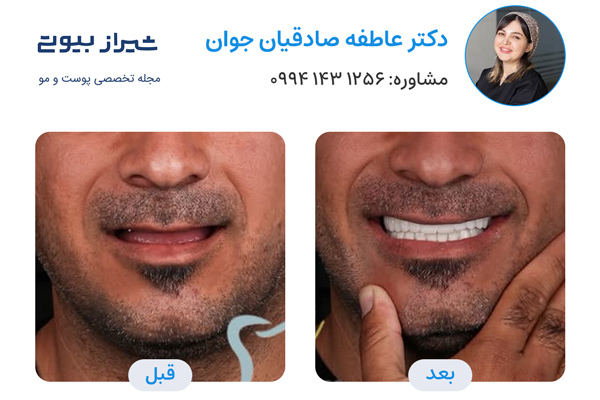 ایمپلنت دندان در شیراز - دکتر عاطفه صادقیان جوان