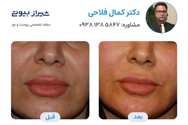 بهترین دکتر تزریق بوتاکس در شیراز - دکتر کمال فلاحی