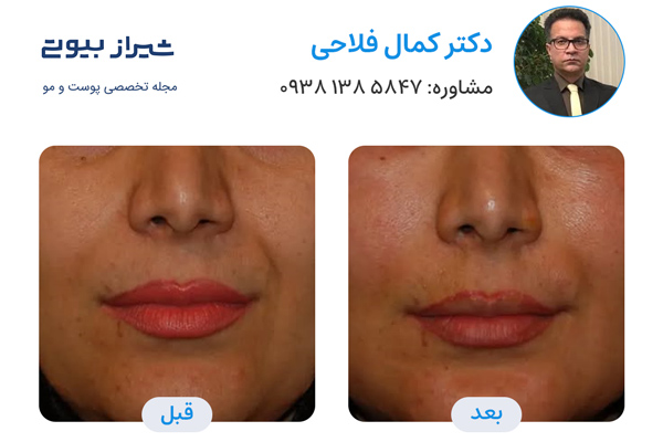 بهترین دکتر تزریق بوتاکس در شیراز - دکتر کمال فلاحی