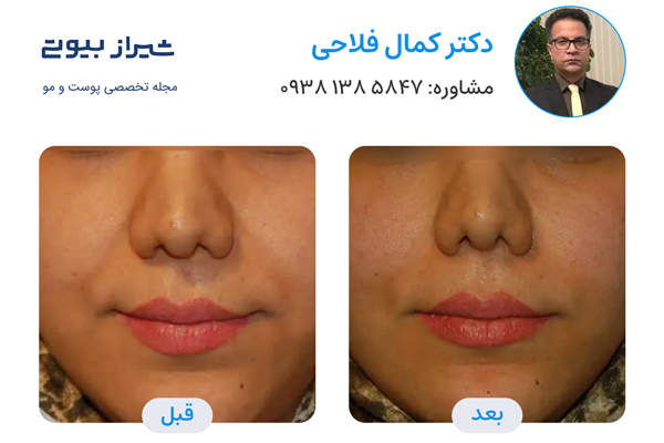 بهترین دکتر تزریق بوتاکس در شیراز - دکتر کمال فلاحی