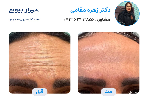 بهترین دکتر تزریق بوتاکس در شیراز - دکتر زهره مقامی