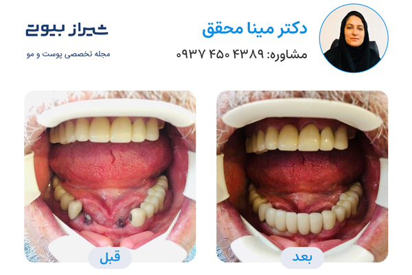 بهترین دکتر ایمپلنت دندان در شیراز - دکتر مینا محقق