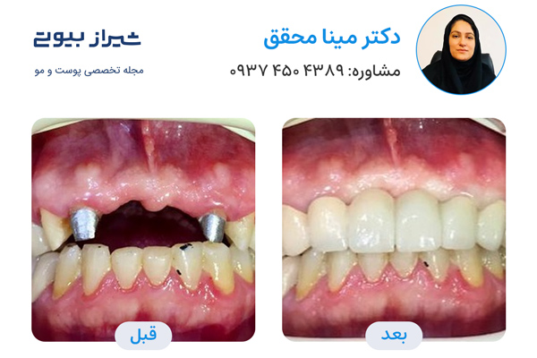 بهترین دکتر ایمپلنت دندان در شیراز - دکتر مینا محقق