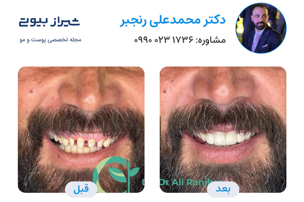 لمینت دندان در شیراز - دکتر محمدعلی رنجبر
