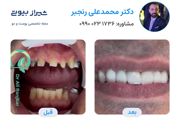 لمینت دندان در شیراز - دکتر محمدعلی رنجبر