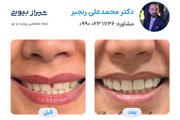 لمینت دندان در شیراز - دکتر محمدعلی رنجبر