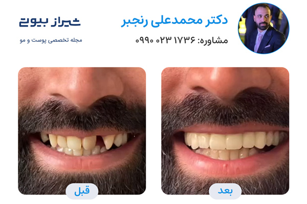 لمینت دندان در شیراز - دکتر محمدعلی رنجبر