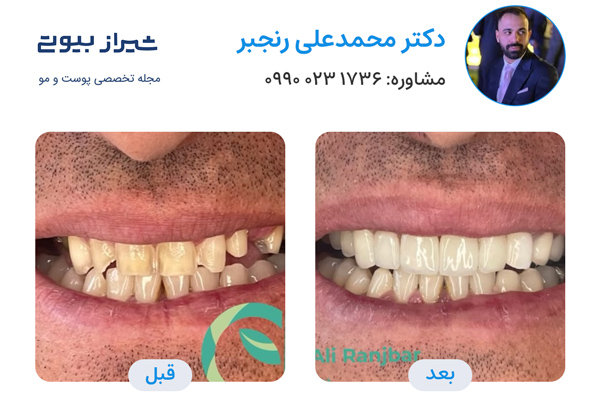 لمینت دندان در شیراز - دکتر محمدعلی رنجبر