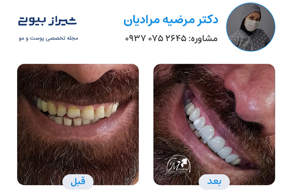 لمینت دندان در شیراز - دکتر مرضیه مرادیان