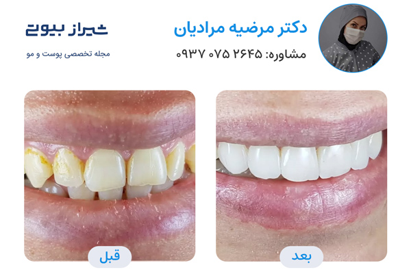 لمینت دندان در شیراز - دکتر مرضیه مرادیان