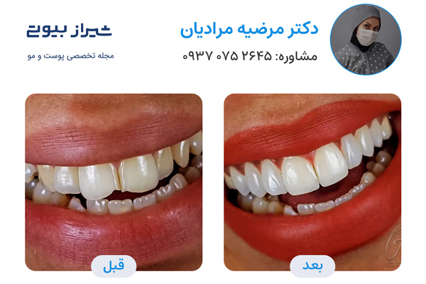 لمینت دندان در شیراز - دکتر مرضیه مرادیان