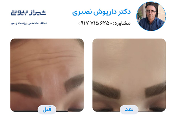 دکتر تزریق بوتاکس شیراز - دکتر داریوش نصیری