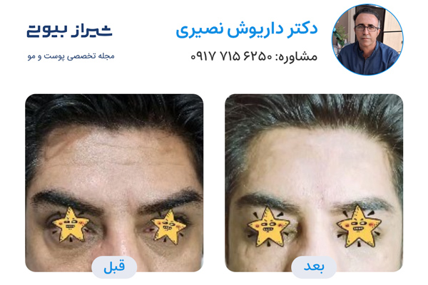 دکتر تزریق بوتاکس شیراز - دکتر داریوش نصیری
