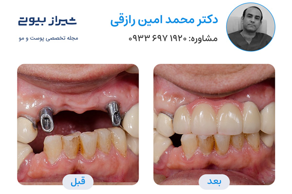 بهترین دکتر ایمپلنت دندان در شیراز - دکتر محمد امین رازقی