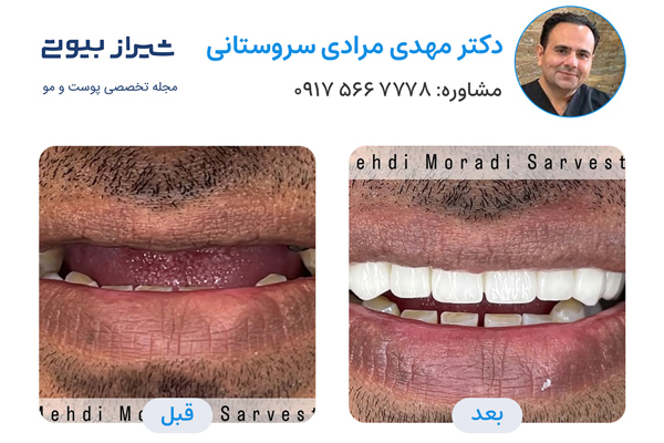 بهترین دکتر ایمپلنت دندان در شیراز - دکتر مهدی مرادی سروستانی