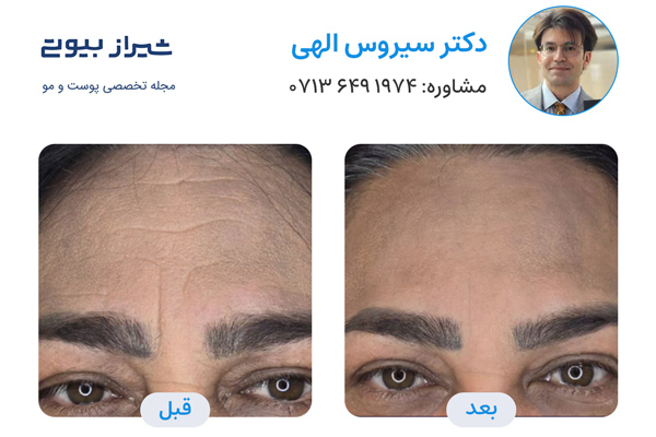 تزریق بوتاکس در شیراز - دکتر سیروس الهی