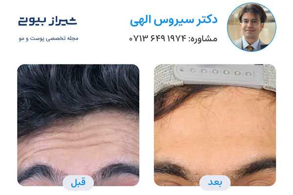تزریق بوتاکس در شیراز - دکتر سیروس الهی