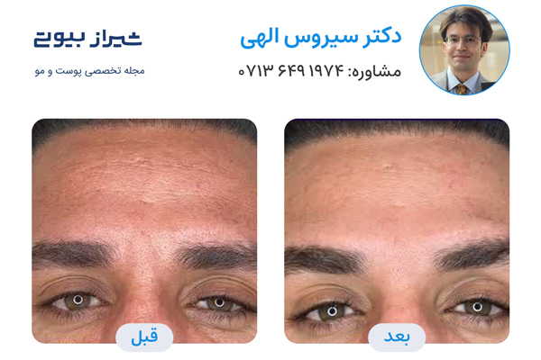 تزریق بوتاکس در شیراز - دکتر سیروس الهی