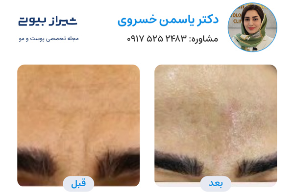 تزریق بوتاکس در شیراز - دکتر یاسمن خسروی