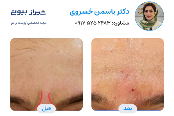 تزریق بوتاکس در شیراز - دکتر یاسمن خسروی