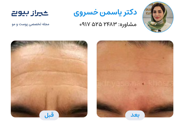 تزریق بوتاکس در شیراز - دکتر یاسمن خسروی