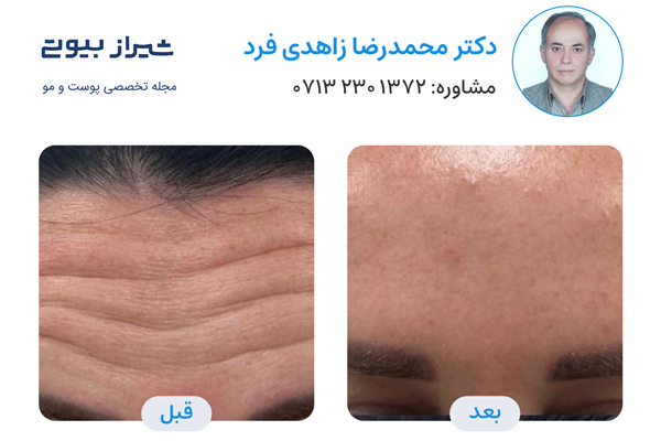 تزریق بوتاکس در شیراز - دکتر محمدرضا زاهدی فرد