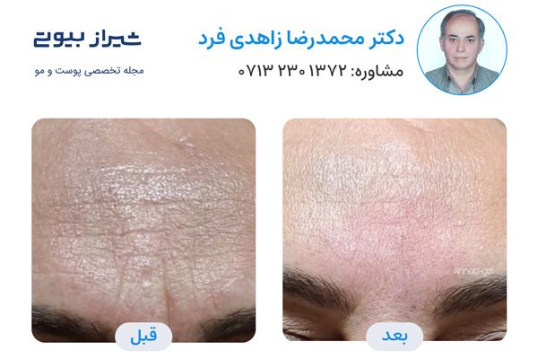 تزریق بوتاکس در شیراز - دکتر محمدرضا زاهدی فرد