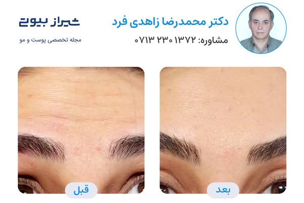 تزریق بوتاکس در شیراز - دکتر محمدرضا زاهدی فرد